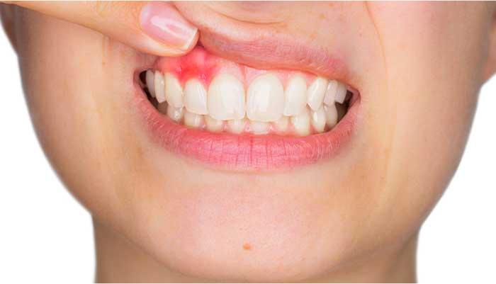 歯ぐきが下がる（痩せる）・歯周炎の悪化