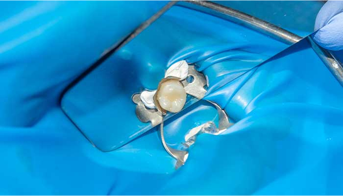 ラバーダムとは