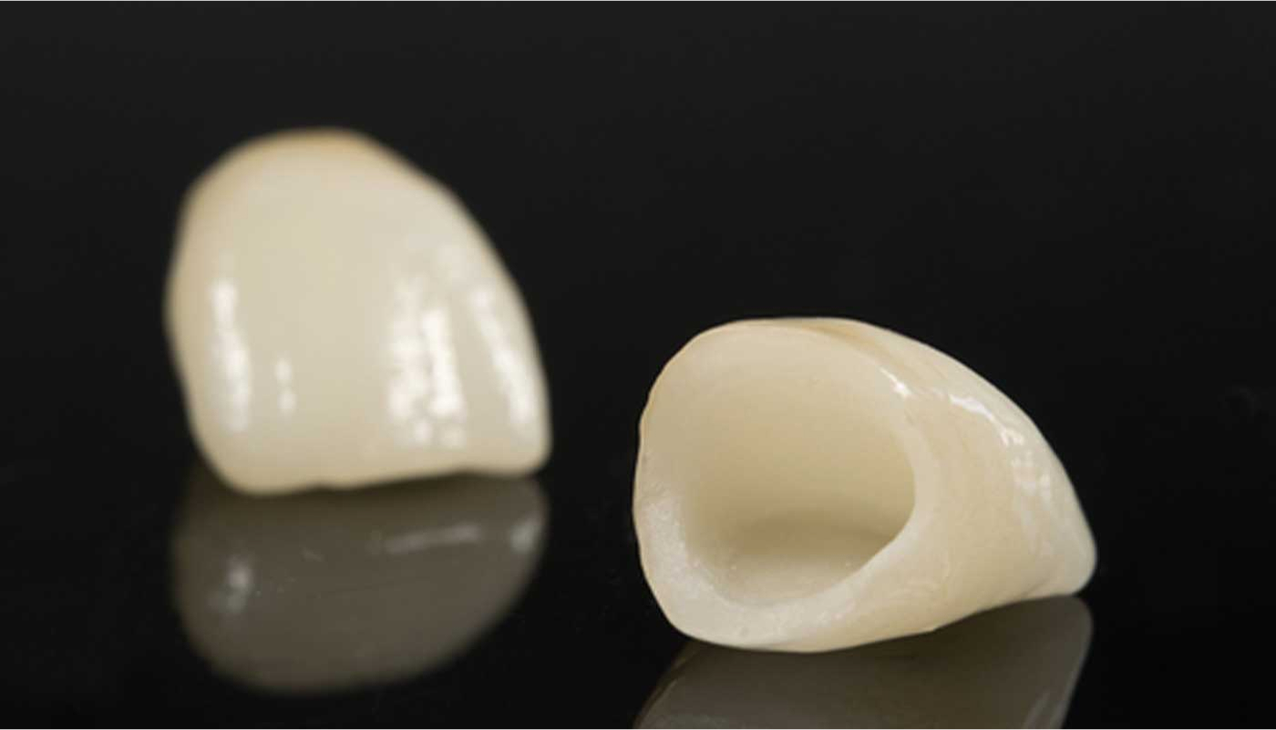 オールセラミッククラウン（emax)